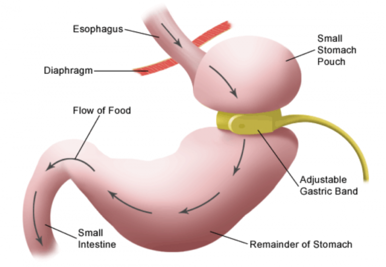 Gastric Banding Melbourne 768x531