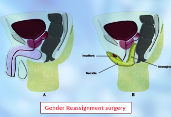 1689603959gender reassignment surgery