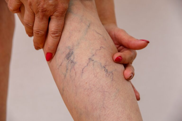 Copy of Spider veins red nails shutterstock 1229171323 1 scaled 1 768x512