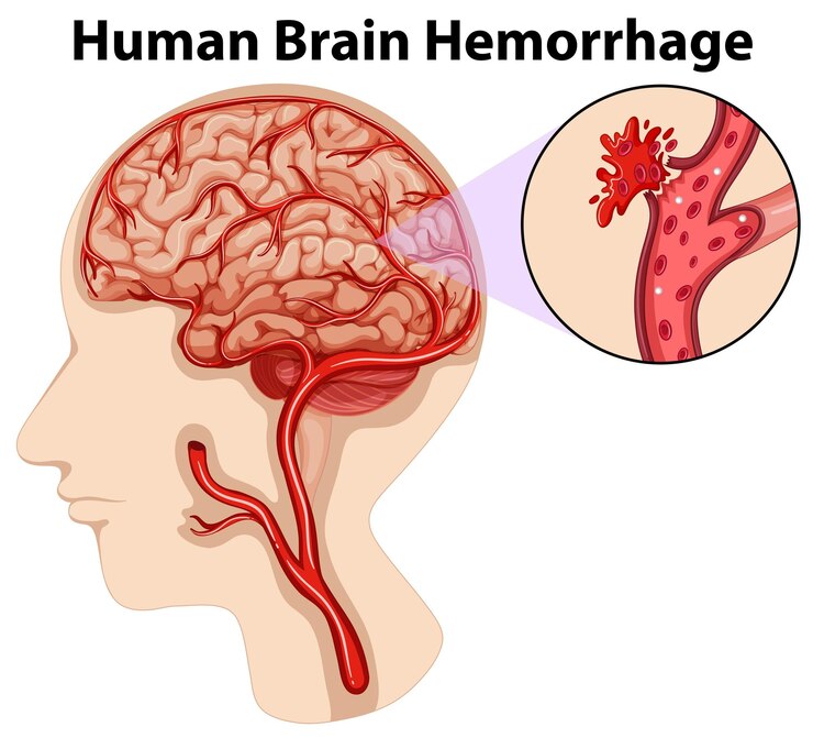 diagram human brain hemorrhage 1308 73220