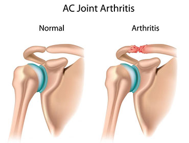 Shoulder replacement in Assam