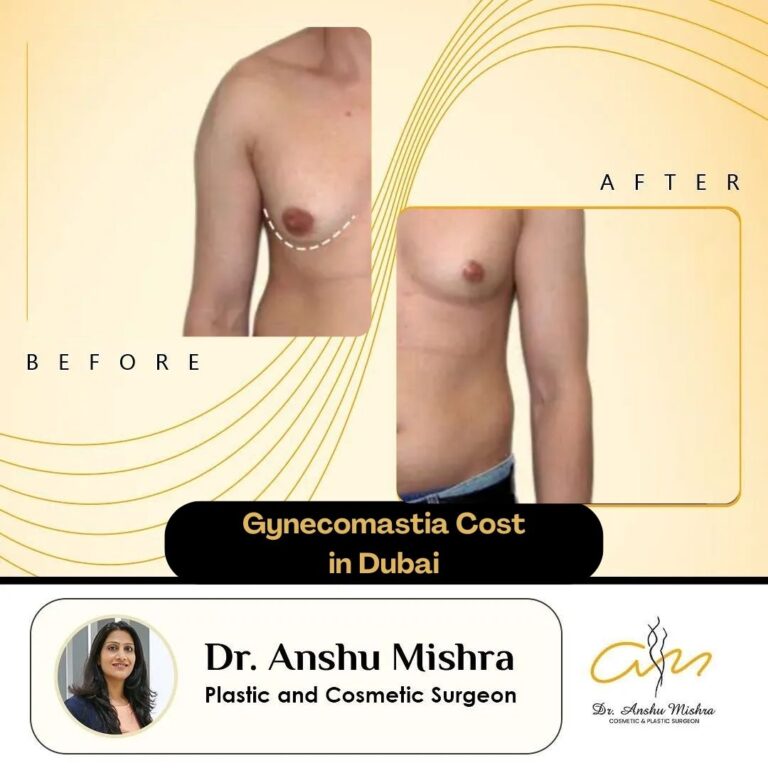 gynecomastia cost in Dubai 768x768