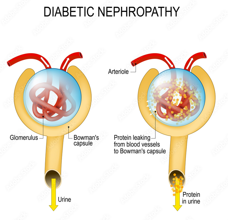 Diabetic Nephropathy Doctors