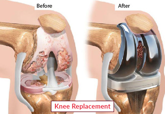 1681194888knee replacement