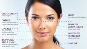 dermal fillers face areas best injectable wrinkle removal treatment.png 300x169 2